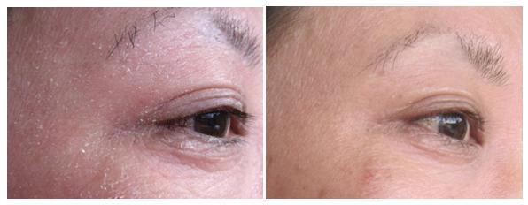 Pirms un pēc neirodermīta ārstēšanas