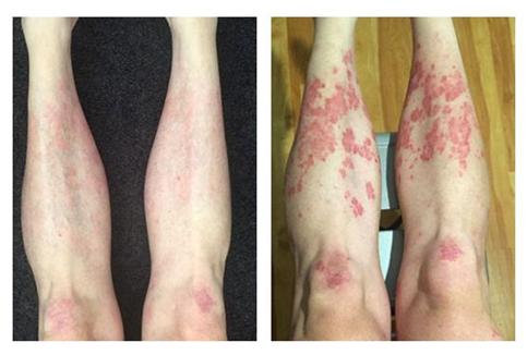 Pirms un pēc psoriāzes ārstēšanas