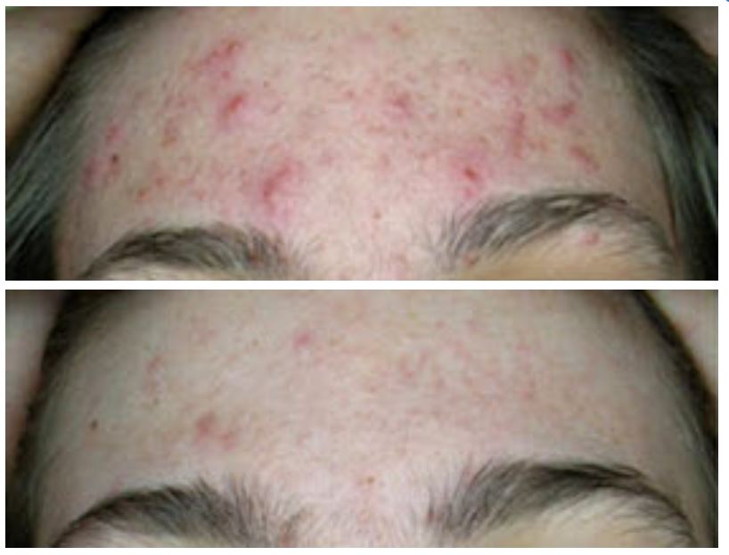 Before and after therapy of Acne