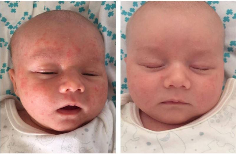 Pirms un pēc novājināta barjerslāņa ārstēšanas