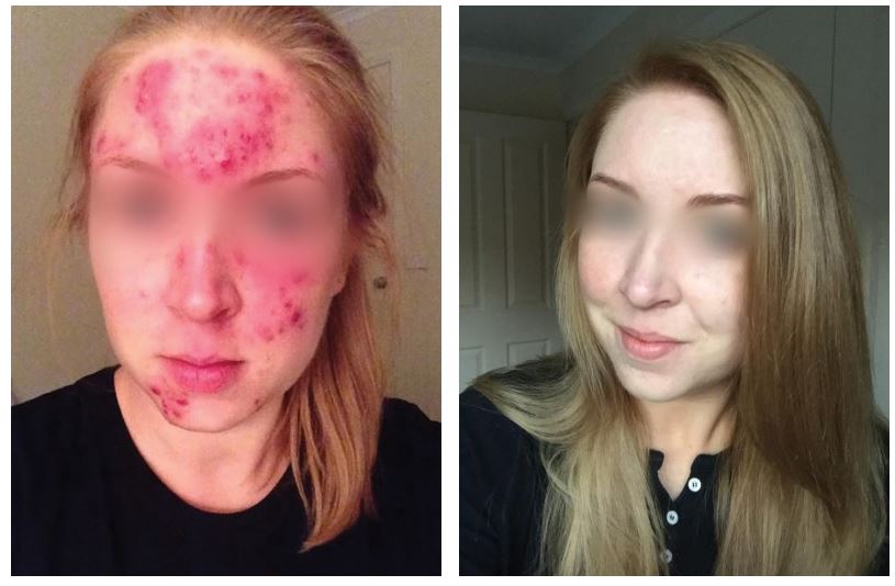 Before and after therapy of Acne