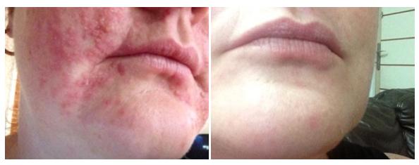 Pirms un pēc iekaisuma procesa ārstēšanas