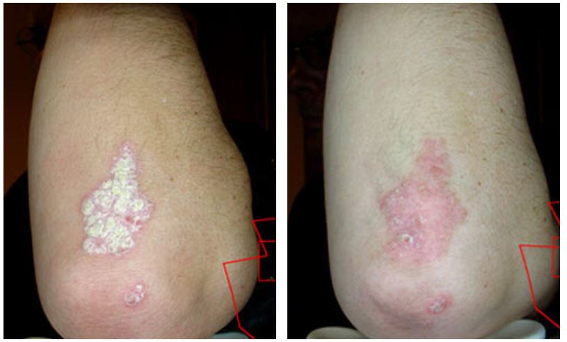 Before and after therapy of Psoriasys