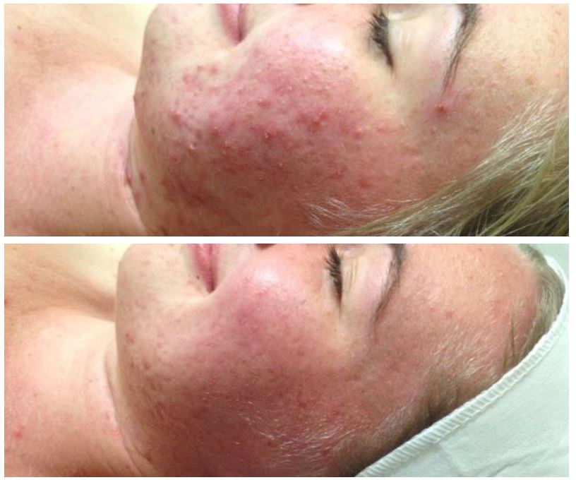 Before and after therapy of Acne