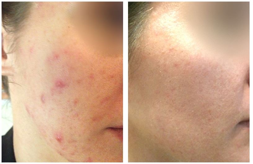 Before and after therapy of Mild Acne